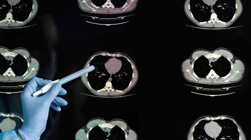 A hand holding a pen pointing to a CT scan of lungs. A hand holding a pen pointing to a CT scan of lungs.